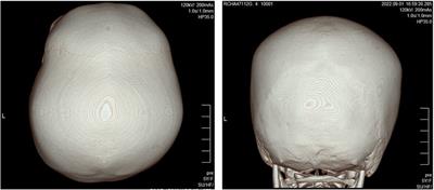 A novel pathogenic variant of DNMT3A associated with craniosynostosis: a case report of Heyn–Sproul–Jackson syndrome